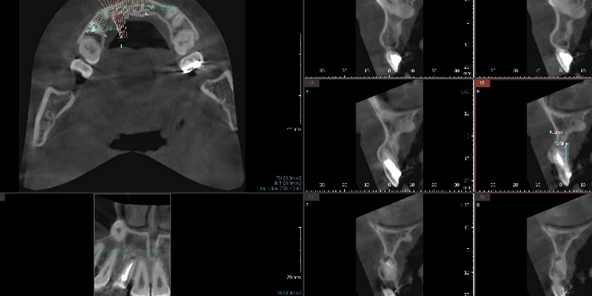 임플란트 뼈이식 필요 여부를 판단하는 CT 단면 — 잔존골 높이와 폭