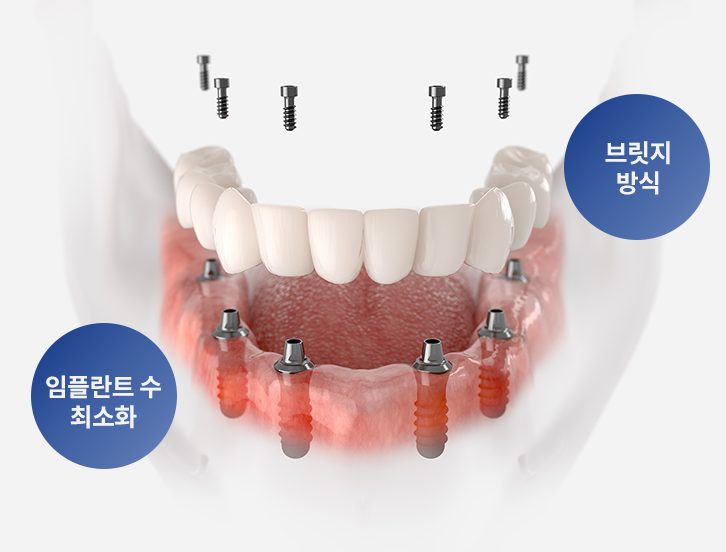전체 임플란트·풀아치 고정 보철 모식도 — 임플란트 4~6개로 전악 보철