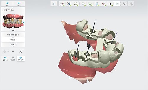 하루 임플란트 — 3D 계획 소프트웨어로 식립 위치와 임시보철을 미리 설계