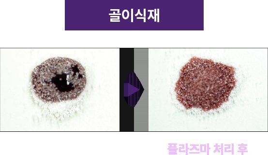 잇몸뼈이식에 쓰이는 골이식재