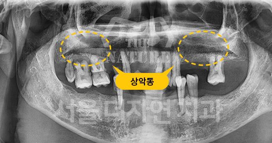 위 어금니 임플란트와 상악동 위치를 표시한 엑스레이