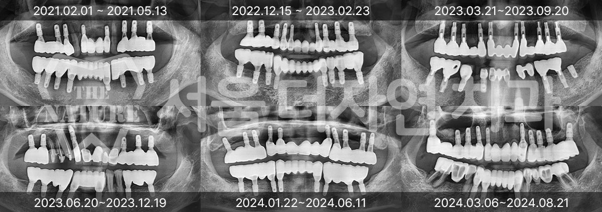 임플란트 수명 — 수년에 걸친 정기 점검 엑스레이